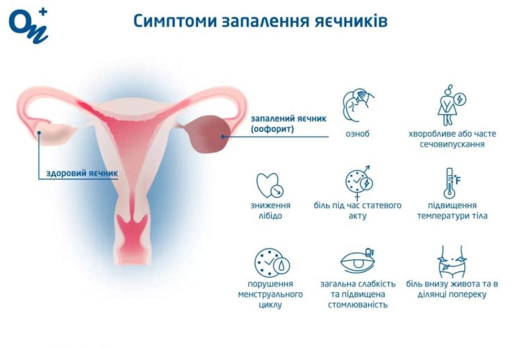 болять яєчники що робити в домашніх умовах