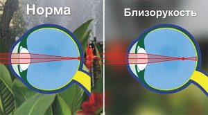 Висока короткозорість і сітківка: приховані ризики, про які варто знати